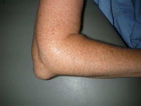 what is a bursitis infection.